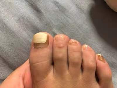 灰指甲的早期症状？