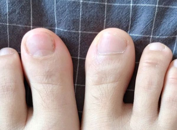 灰指甲的早期症状？