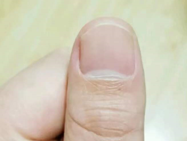 灰指甲真的很难治疗吗？